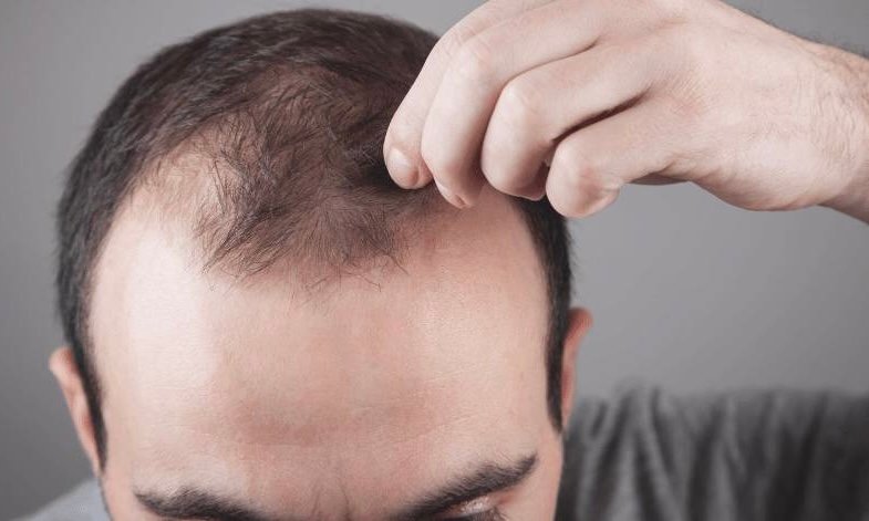हेयर फॉल कैसे रोकें? 4 प्राकृतिक उपाय जो वास्तव में मदद कर सकते हैं